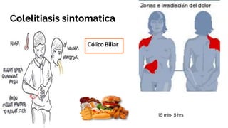 Colelitiasis sintomatica
Cólico Biliar
15 min- 5 hrs
 