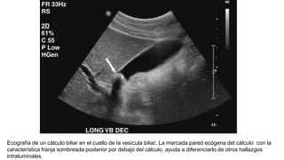 Ecografía de un cálculo biliar en el cuello de la vesícula biliar. La marcada pared ecógena del cálculo con la
característica franja sombreada posterior por debajo del cálculo, ayuda a diferenciarlo de otros hallazgos
intraluminales.
 