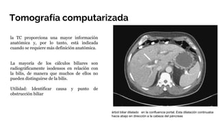 Tomografía computarizada
la TC proporciona una mayor información
anatómica y, por lo tanto, está indicada
cuando se requiere más definición anatómica.
La mayoría de los cálculos biliares son
radiográficamente isodensos en relación con
la bilis, de manera que muchos de ellos no
pueden distinguirse de la bilis.
Utilidad: Identificar causa y punto de
obstrucción biliar
árbol biliar dilatado en la confluencia portal. Esta dilatación continuaba
hacia abajo en dirección a la cabeza del páncreas
 