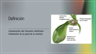 Deﬁnición
Complicación más frecuente colelitiasis
Inflamación de la pared de la vesícula
 