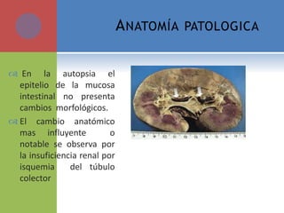 En la autopsia el
epitelio de la mucosa
intestinal no presenta
cambios morfológicos.
 El cambio anatómico
mas influyente o
notable se observa por
la insuficiencia renal por
isquemia del túbulo
colector
ANATOMÍA PATOLOGICA
 