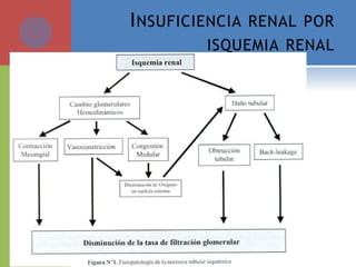 INSUFICIENCIA RENAL POR
ISQUEMIA RENAL
 