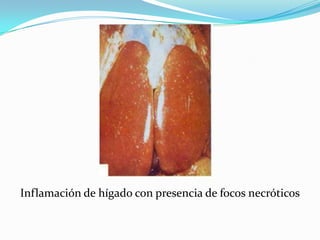 Inflamación de hígado con presencia de focos necróticos
 