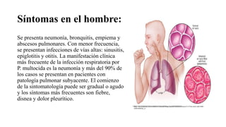 Síntomas en el hombre:
Se presenta neumonía, bronquitis, empiema y
abscesos pulmonares. Con menor frecuencia,
se presentan infecciones de vías altas: sinusitis,
epiglotitis y otitis. La manifestación clínica
más frecuente de la infección respiratoria por
P. multocida es la neumonía y más del 90% de
los casos se presentan en pacientes con
patología pulmonar subyacente. El comienzo
de la sintomatología puede ser gradual o agudo
y los síntomas más frecuentes son fiebre,
disnea y dolor pleurítico.
https://res.cloudinary.com/middlesex-hospital/image/upload/mhsMayoMedia/671275b4-a4e6-4a86-8f06-
eb8b18b002fa_es
 