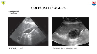 COLECISTITE AGUDA
Diagnóstico
Imagem
SCHWARTZ, 2013 Townsend, MC – Sebastian, 2013
 