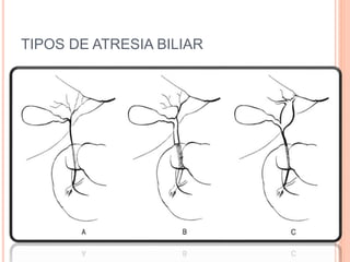 TIPOS DE ATRESIA BILIAR
 