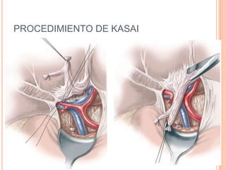 PROCEDIMIENTO DE KASAI
 