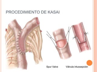 PROCEDIMIENTO DE KASAI
Spur Valve Válvula intussepción
 