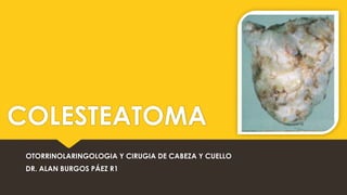 COLESTEATOMA
OTORRINOLARINGOLOGIA Y CIRUGIA DE CABEZA Y CUELLO
DR. ALAN BURGOS PÁEZ R1

 