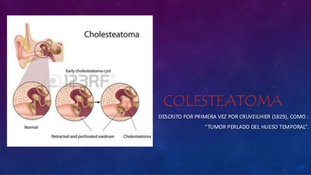 Colesteatoma