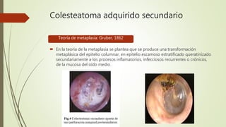 Colesteatoma adquirido secundario
 En la teoría de la metaplasia se plantea que se produce una transformación
metaplásica del epitelio columnar, en epitelio escamoso estratificado queratinizado
secundariamente a los procesos inflamatorios, infecciosos recurrentes o crónicos,
de la mucosa del oído medio.
Teoría de metaplasia: Gruber, 1862
 