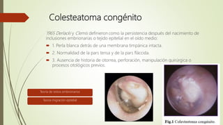 Colesteatoma congénito
1965 Derlacki y Clemis definieron como la persistencia después del nacimiento de
inclusiones embrionarias o tejido epitelial en el oído medio:
 1. Perla blanca detrás de una membrana timpánica intacta.
 2. Normalidad de la pars tensa y de la pars fláccida.
 3. Ausencia de historia de otorrea, perforación, manipulación quirúrgica o
procesos otológicos previos.
Teoría de restos embrionarios
Teoría migración epitelial
 