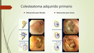 Colesteatoma adquirido primario
 Retracción pars flacida  Retracción pars tensa
 