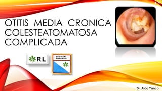 OTITIS MEDIA CRONICA
COLESTEATOMATOSA
COMPLICADA
B´H
Dr. Aldo Yanco
 