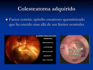 Colesteatoma adquirido
   Factor común: epitelio escamoso queratinizado
    que ha crecido mas allá de sus limites normales
 