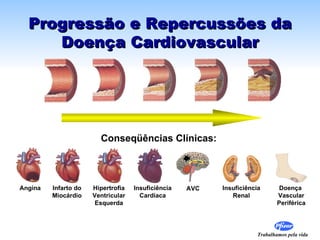 Progressão e Repercussões da
     Doença Cardiovascular




                        Conseqüências Clínicas:



Angina   Infarto do   Hipertrofia   Insuficiência   AVC   Insuficiência        Doença
         Miocárdio    Ventricular     Cardíaca               Renal            Vascular
                       Esquerda                                               Periférica




                                                                      Trabalhamos pela vida
 