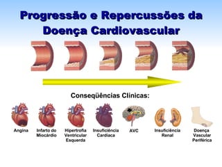 Progressão e Repercussões da Doença Cardiovascular Angina Infarto do  Miocárdio  Hipertrofia Ventricular Esquerda Insuficiência Cardíaca Conseqüências Clínicas: AVC Insuficiência Renal Doença  Vascular Periférica 