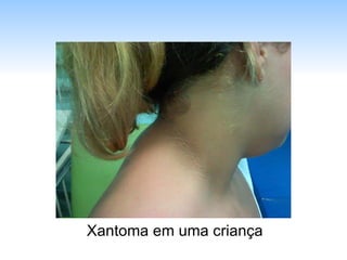 Xantoma em uma criança 