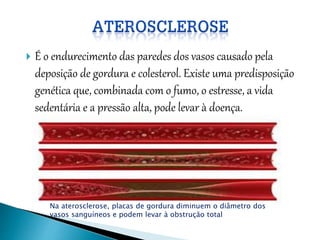  É o endurecimento das paredes dos vasos causado pela
deposição de gordura e colesterol. Existe uma predisposição
genética que, combinada com o fumo, o estresse, a vida
sedentária e a pressão alta, pode levar à doença.
Na aterosclerose, placas de gordura diminuem o diâmetro dos
vasos sanguíneos e podem levar à obstrução total
 