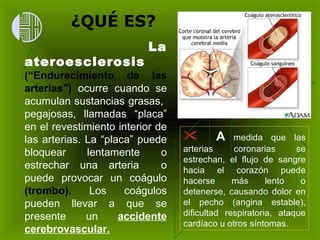 La ateroesclerosis   (“Endurecimiento de las arterias")  ocurre cuando se acumulan sustancias grasas,  pegajosas, llamadas “placa” en el revestimiento interior de las arterias. La “placa” puede bloquear lentamente o estrechar una arteria  o puede provocar un coágulo  (trombo).  Los coágulos pueden llevar a que se presente un  accidente cerebrovascular. A  medida que las arterias coronarias se estrechan, el flujo de sangre hacia el corazón puede hacerse más lento o detenerse, causando dolor en el pecho (angina estable), dificultad respiratoria, ataque cardíaco u otros síntomas.  ¿QUÉ ES? 