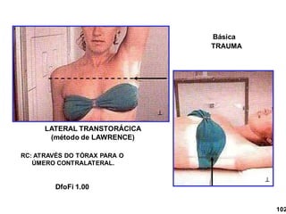 LATERAL TRANSTORÁCICA
(método de LAWRENCE)


RC: ATRAVÉS DO TÓRAX PARA O
ÚMERO CONTRALATERAL.
102
DfoFi 1.00
Básica
TRAUMA
 
