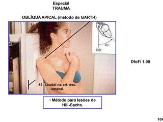 • Método para lesões de
Hill-Sachs.
OBLÍQUA APICAL (método de GARTH)
45 caudal na art. esc.
umeral.
104
DfoFi 1.00
Especial
TRAUMA
 
