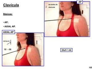 Clavícula
Básicas:
• AP;
• AXIAL AP.
AP
AXIAL AP

ao centro da
clavícula
15 - 30 DfoFi 1.00
CEFÁLICO
105
 