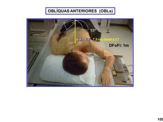 OBLÍQUAS ANTERIORES (OBLs)
15º
T2 – T3 7,5 cm distal à C7
DFoFi: 1m
109

 