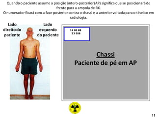 Quandoo paciente assume a posição ântero-posterior(AP) significa que se posicionaráde
frente para a ampola de RX.
O numerador ficará com a face posterior contra o chassi e a anterior voltadapara o técnico em
radiologia.
Lado
direitodo
paciente
Lado
esquerdo
do paciente
Chassi
Paciente de pé em AP
11
 