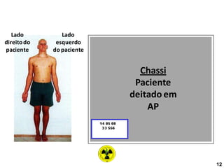 Lado
direitodo
paciente
Lado
esquerdo
do paciente
Chassi
Paciente
deitado em
AP
12
 