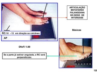 AP
RC:10 - 15 em direção ao calcâneo
ARTICULAÇÃO
METATARSO
FALANGEANA
DO DEDO DE
INTERESSE
Se a parte já estiver angulada, o RC será
perpendicular.
Básicas
120
DfoFi 1.00
 