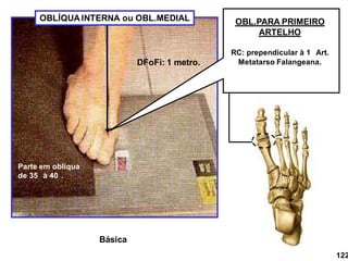 Parte em oblíqua
de 35 à 40 .
OBL.PARA PRIMEIRO
ARTELHO
RC: prependicular à 1 Art.
Metatarso Falangeana.
DFoFi: 1 metro.
122
OBLÍQUA INTERNA ou OBL.MEDIAL
Básica
 