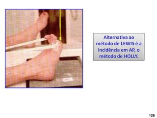Alternativa ao
método de LEWIS é a
incidência em AP, o
método de HOLLY.
126
 