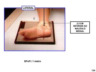 DFoFi: 1 metro
LATERAL

2,5 CM
INFERIOR AO
MALÉOLO
MEDIAL
134
 