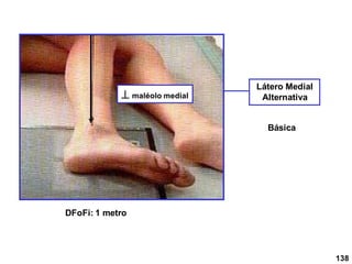 DFoFi: 1 metro
Látero Medial
Alternativa
 maléolo medial
138
Básica
 