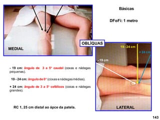 143
LATERAL
MEDIAL
DFoFi: 1 metro
RC 1, 25 cm distal ao ápce da patela.
- 19 cm: ângulo de 3 a 5 caudal (coxas e nádegas
pequenas).
19 - 24 cm: ângulo de 0 (coxas e nádegasmédias).
+ 24 cm: ângulo de 3 a 5 cefálicos (coxas e nádegas
grandes).
- 19 cm
19 - 24 cm
+ 24 cm
OBLÍQUAS
Básicas
 