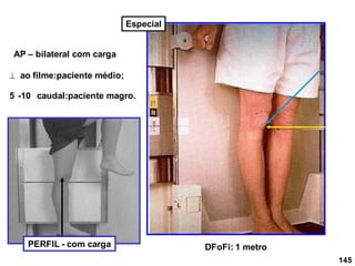 145
AP – bilateral com carga
 ao filme:paciente médio;
5 -10 caudal:paciente magro.
DFoFi: 1 metro
PERFIL - com carga
Especial
 