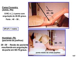 147
Camp Coventry
(AXIAL-PA)
40 - 50
Homblad - PA
(paciente de joelhos)
60 - 70
20 -30 - flexão do paciente
resultando em angulação
da parte em 60-70 graus.
O RC é  à perna com
angulação de 40-50 graus.
ponto médio da crista poplítea
DFoFi: 1 metro
Parte : 40 - 50 .
20 - 30
 
