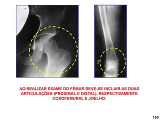 150
AO REALIZAR EXAME DO FÊMUR DEVE-SE INCLUIR AS DUAS
ARTICULAÇÕES (PROXIMAL E DISTAL), RESPECTIVAMENTE
COXOFEMURAL E JOELHO.
 
