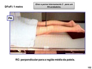 Girar a perna internamente 5 para um
PAverdadeiro.
DFoFi:1 metro
PA
RC: perpendicular para a região média da patela.
152
 