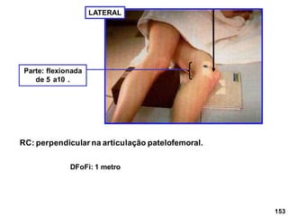 153
LATERAL
Parte: flexionada
de 5 a10 .
RC: perpendicular na articulação patelofemoral.
DFoFi: 1 metro
 