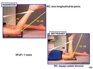 155
HUGHSTON
15 -20
45
90
15 -20
DFoFi: 1 metro
RC: eixo longitudinal da perna.
RC: espaço patelo femoral.
SETTEGAST
 