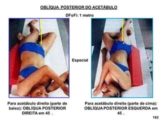 162
OBLÍQUA POSTERIOR DO ACETÁBULO
Para acetábulo direito (parte de
baixo): OBLÍQUA POSTERIOR
DIREITA em 45 .
DFoFi: 1 metro
Para acetábulo direito (parte de cima):
OBLÍQUA POSTERIOR ESQUERDA em
45 .
Especial
 