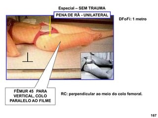 167
Especial – SEM TRAUMA
FÊMUR 45 PARA
VERTICAL, COLO
PARALELO AO FILME
RC: perpendicular ao meio do colo femoral.
DFoFi: 1 metro
PENA DE RÃ - UNILATERAL
 