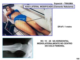 168
AXIO LATERAL MODIFICADO (Clements Nakaiama)
Especial – TRAUMA
RC: 15 - 20 NA HORIZONTAL
MEDIOLATERALMENTE NO CENTRO
DO COLO FEMORAL
DFoFi: 1 metro
 