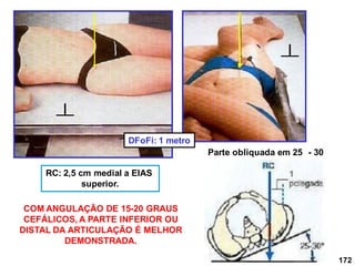 172
RC: 2,5 cm medial a EIAS
superior.
DFoFi: 1 metro
Parte obliquada em 25 - 30
COM ANGULAÇÃO DE 15-20 GRAUS
CEFÁLICOS, A PARTE INFERIOR OU
DISTAL DA ARTICULAÇÃO É MELHOR
DEMONSTRADA.
 