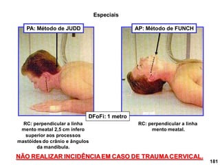 181
PA: Método de JUDD
RC: perpendicular a linha
mento meatal.
RC: perpendicular a linha
mento meatal 2,5 cm ínfero
superior aos processos
mastóides do crânio e ângulos
da mandíbula.
NÃO REALIZAR INCIDÊNCIAEM CASO DE TRAUMACERVICAL.
DFoFi: 1 metro
Especiais
AP: Método de FUNCH
 