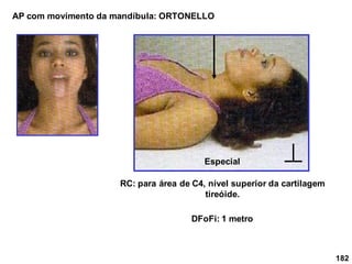 182
AP com movimento da mandíbula: ORTONELLO
RC: para área de C4, nível superior da cartilagem
tireóide.
DFoFi: 1 metro
Especial
 
