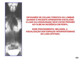 185
EM EXAMES DE COLUNA TORÁCICA OU LOMBAR
QUANDO O PACIENTE APRESENTAR ESCOLIOSE,
O LADO DA CONVEXIDADE DEVE ESTAR PRÓXIMO
AO FILME NA INCIDÊNCIA EM PERFIL.
ESSE PROCEDIMENTO, MELHORA A
VISUALIZAÇÃO DOS ESPAÇOS INTERVERTEBRAIS
DO LADO AFETADO.
 