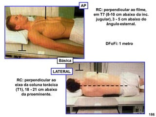 186
AP
RC: perpendicular ao filme,
em T7 (8-10 cm abaixo da inc.
jugular), 3 - 5 cm abaixo do
ângulo esternal.
LATERAL
DFoFi: 1 metro
RC: perpendicular ao
eixo da coluna torácica
(T1), 18 - 21 cm abaixo
da proeminente.
Básica
 